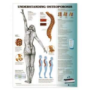 Understanding Osteoporosis Anatomical Chart Unmounted:  